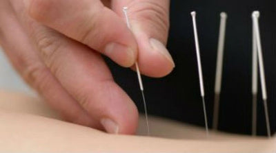 Conheça mais sobre a acupuntura: a agulhada que salva! 